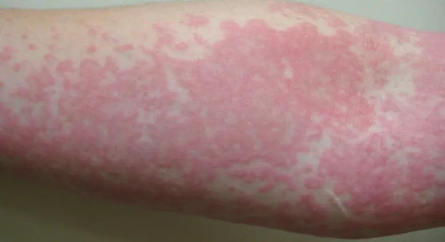 Brazo con extensas ronchas rojas en la piel, indicando una posible reacción alérgica o irritación cutánea.