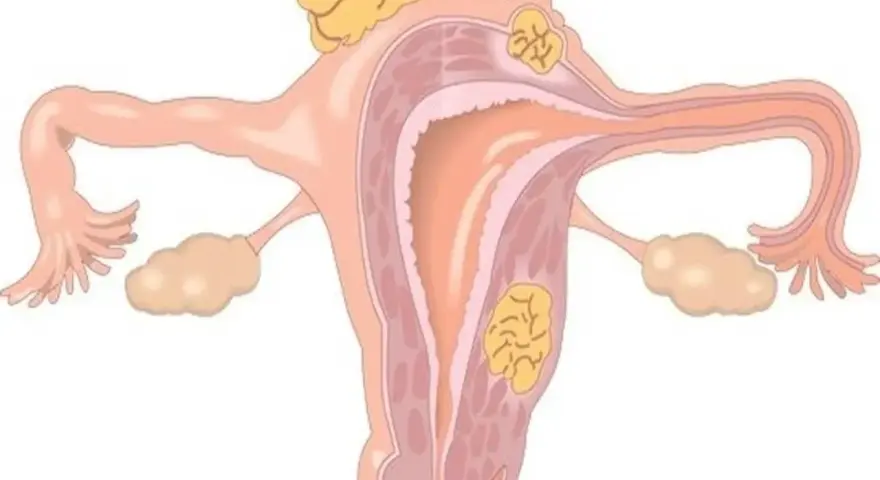 Anatomical illustration of a uterus with fibroids. Warto wiedzieć, ile cm ma macica, by monitorować jej stan.