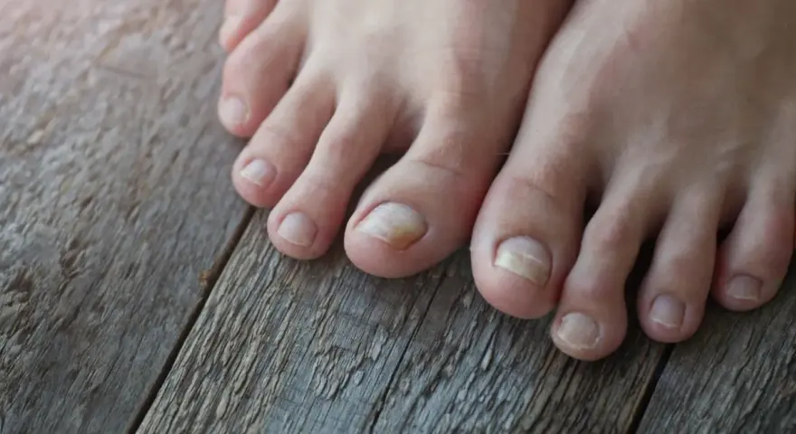 Dedos de los pies con uñas afectadas por tipos hongos en los pies, mostrando decoloración y engrosamiento.