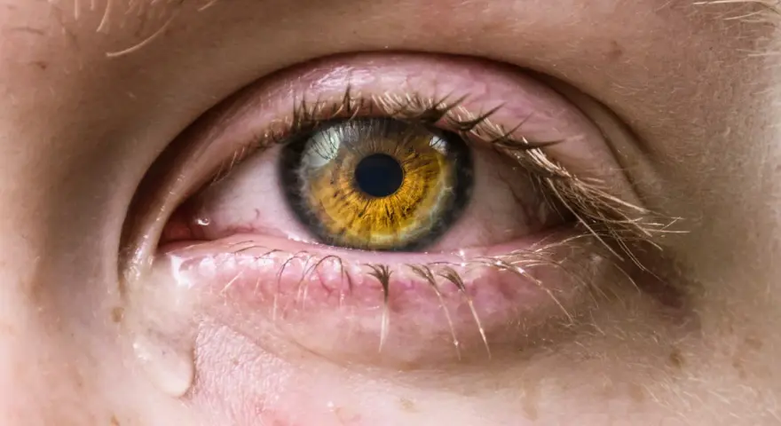 Occhio con iride dorata, palpebre arrossate e lacrime che scendono, sintomo di occhio secco grave.