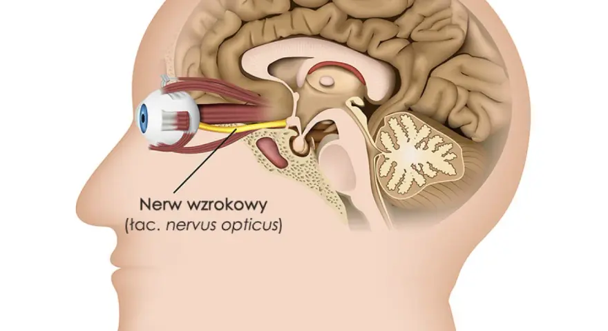 Przekrój głowy ukazujący oko i nerw wzrokowy. Obrzęk tarczy nerwu wzrokowego objawy mogą być widoczne w tej okolicy.