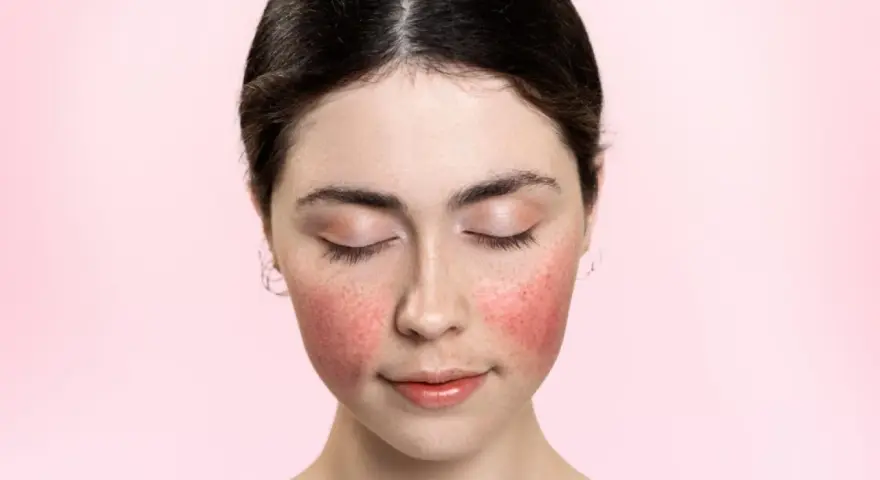 Rötungen im Gesicht, vielleicht eine retinol warnung? Die Haut ist gerötet, die Augen geschlossen.