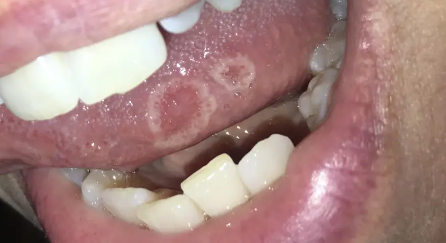 Lingua con afte dolorose. Le lesioni biancastre e rosse sono visibili sulla superficie della lingua, circondate da un alone infiammato.
