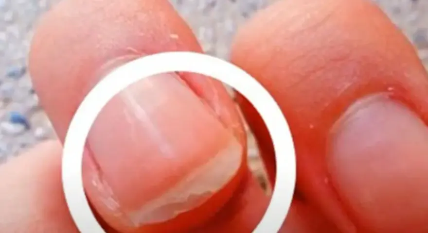 Gros plan sur un ongle qui se dédouble, montrant les couches séparées. Comprendre pourquoi les ongles se dédoublent peut aider à prévenir ce problème.