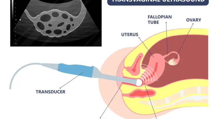 Transvaginaler Ultraschall zur Diagnose von Endometriose. Ein Ultraschallkopf wird in die Vagina eingeführt, um Gebärmutter, Eierstöcke und Eileiter abzubilden.