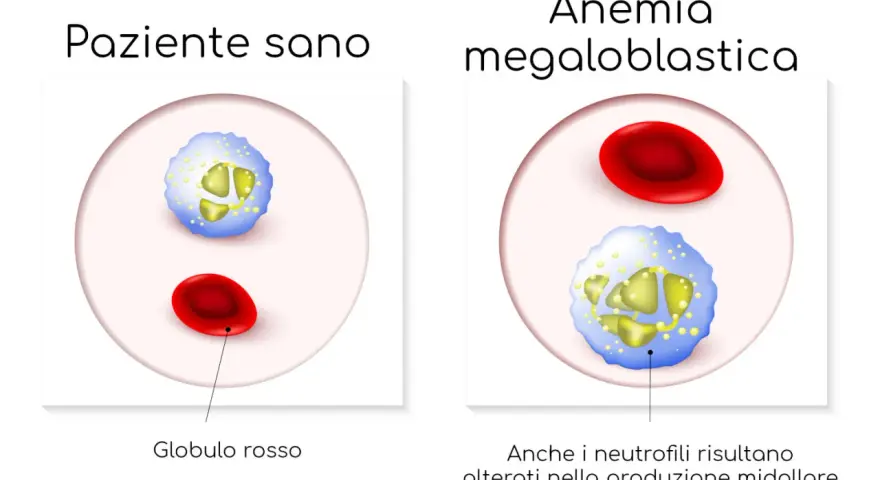 Confronto tra globuli rossi e neutrofili di un paziente sano e uno con anemia megaloblastica, dove i neutrofili appaiono alterati.