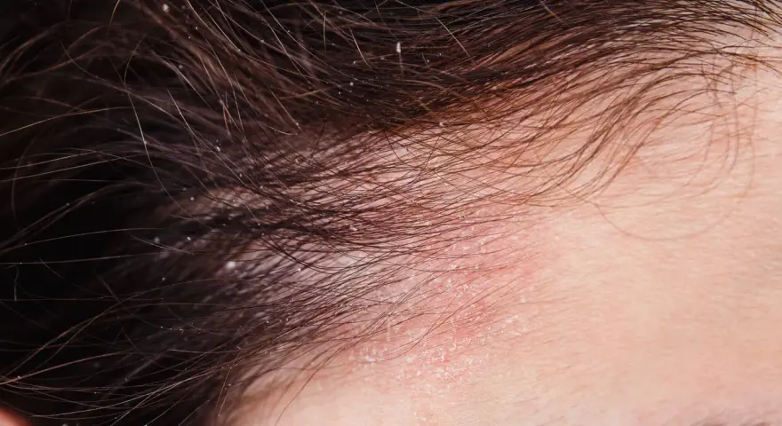 Nahaufnahme der Kopfhaut mit roten, schuppigen Stellen und feinen Haaren. Dies deutet auf Schuppenflechte am Kopfhautrand hin, die auch Haarausfall verursachen kann.
