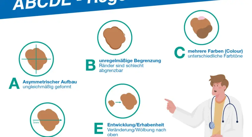 ABCDE-Regel: Asymmetrie, Begrenzung, Color, Durchmesser, Entwicklung. So können Sie Hautkrebs-Symptome frühzeitig erkennen.