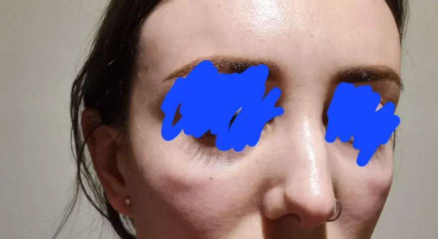 Widoczna opuchlizna po laserze frakcyjnym pod oczami i na policzkach. Skóra jest lekko zaczerwieniona i błyszcząca.