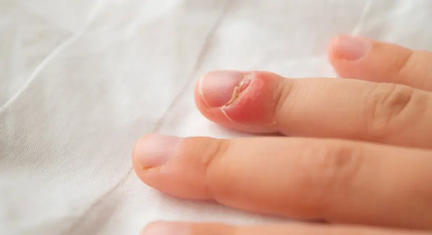 Gros plan sur un doigt d'enfant présentant une rougeur et une inflammation autour de l'ongle, suggérant une mycose ongle bébé.