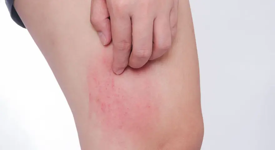 Rote, juckende Stelle am Bein, ein mögliches Symptom von Diabetes haut.