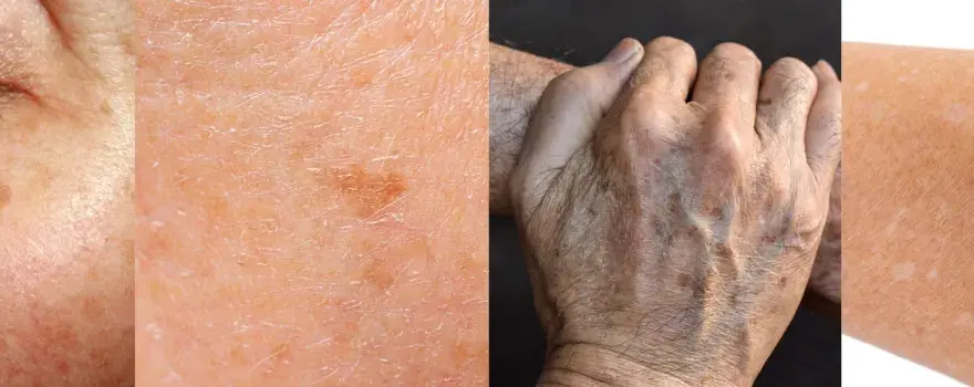 Nahaufnahme von Haut mit Pigmentflecken, Falten und Altersflecken. Retinol gegen Pigmentflecken kann helfen, das Hautbild zu verbessern.