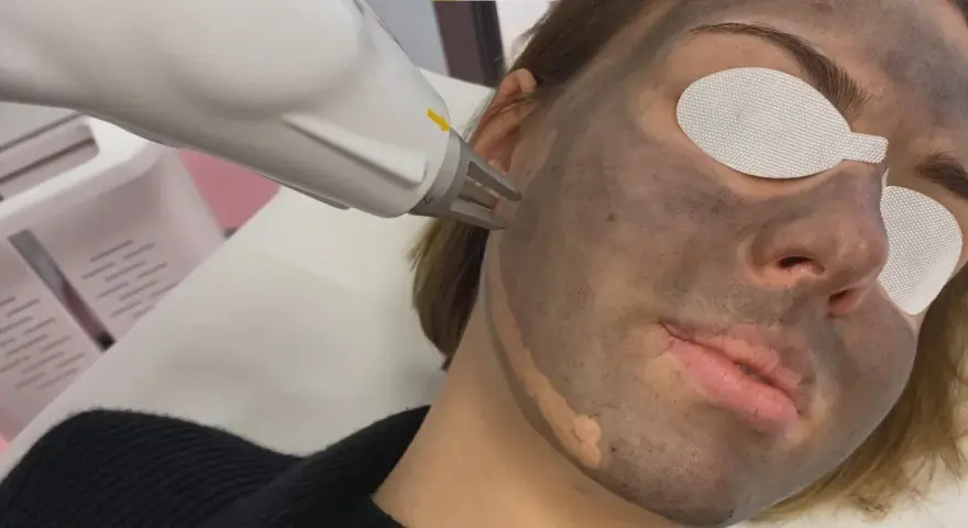 Zabieg laserowy na twarz z maską węglową. Skóra przygotowana do peelingu węglowego.