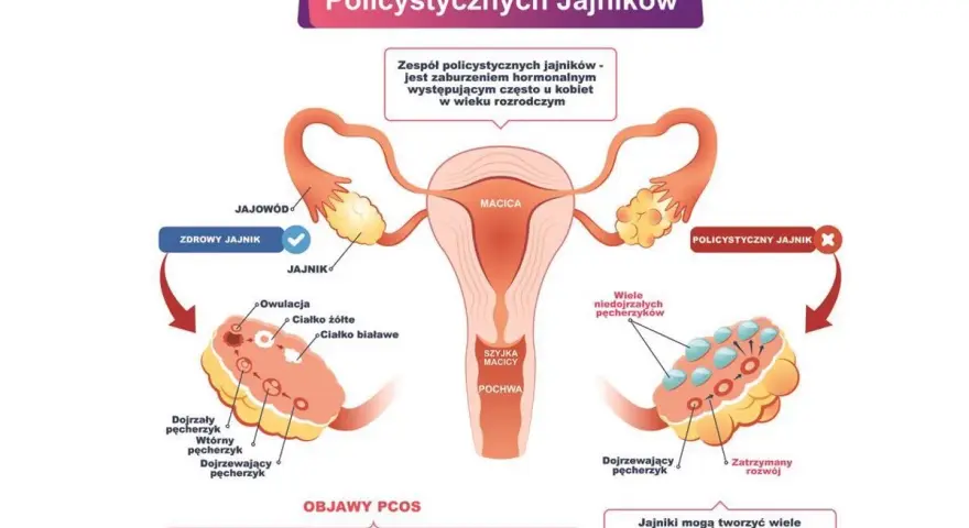 Ilustracja przedstawia budowę jajników, porównując zdrowy jajnik z jajnikiem w zespole policystycznych jajników (PCOS). W tym drugim widoczne są liczne niedojrzałe pęcherzyki.