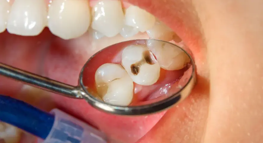Zęby z próchnicą widziane w lusterku dentystycznym. Ksylitol, naturalny słodzik, może pomóc w zapobieganiu próchnicy.