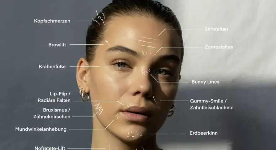 Gesicht einer Frau mit Markierungen für Botox-Behandlungen, die Stirnfalten und die falte zwischen den augen hervorheben.