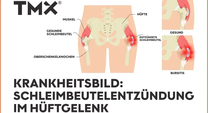Illustration zeigt das Hüftgelenk mit gesunden und entzündeten Schleimbeuteln. Bursitis trochanterica als Krankheitsbild.