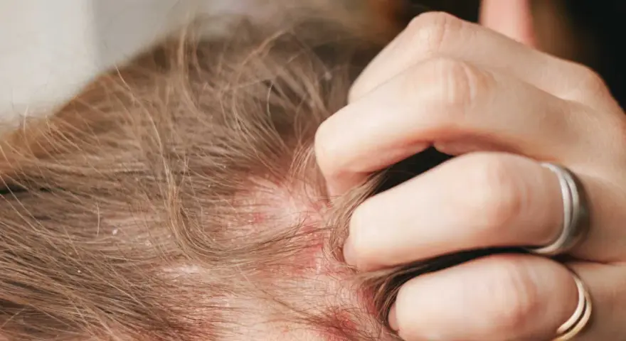 Juckende Kopfhaut mit Rötungen und Schuppen, die auf Neurodermitis hindeuten und zu Haarausfall führen können.