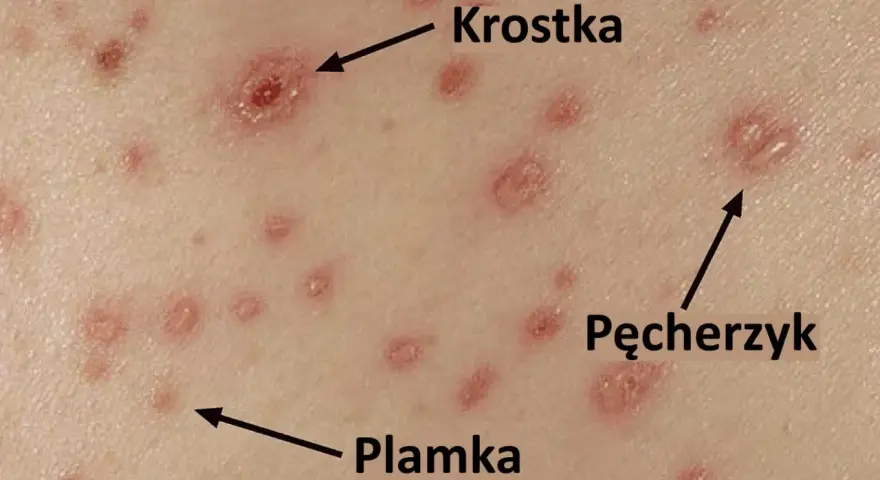 Skóra z licznymi zmianami: plamkami, krostkami i pęcherzykami, typowymi objawami ospy wietrznej.