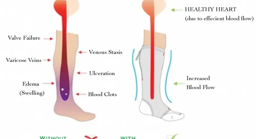 Diagram shows how compression stockings help with inflammation by improving blood flow, preventing issues like edema and varicose veins.
