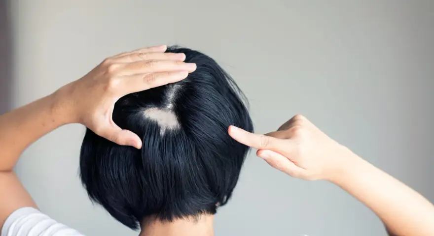 Eine Frau entdeckt kreisrunden Haarausfall am Hinterkopf. Ihre Hände berühren die kahle Stelle, die sich deutlich vom dunklen Haar abhebt.