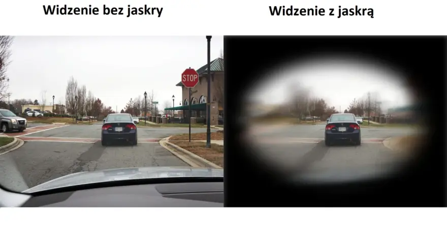 Porównanie widzenia: po lewej - normalne, po prawej - z jaskrą (widoczne ubytki w polu widzenia).