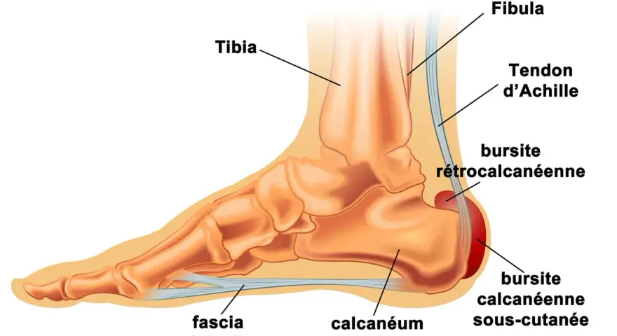 Anatomie du pied montrant le tendon d'Achille, le calcanéum et le fascia plantaire. Un remède de grand-mère pour la tendinite du tendon d'Achille pourrait soulager ces zones.