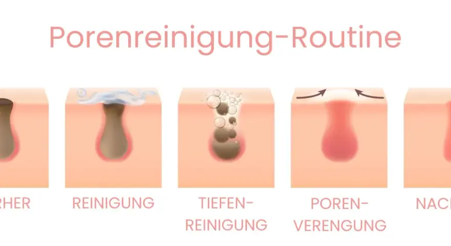 Schritt-für-Schritt-Anleitung zur Porenreinigung: Vorher ein Mitesser, dann Reinigung, Tiefenreinigung, Porenverengung und Nachher. Hilft bei trockener Haut und Mitessern.