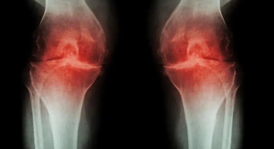 RTG kolan z zaznaczoną osteofitami i zwężeniem szpary stawowej, sugerujące chorobę zwyrodnieniową. Może być wskazana osteotomia podkolanowa.