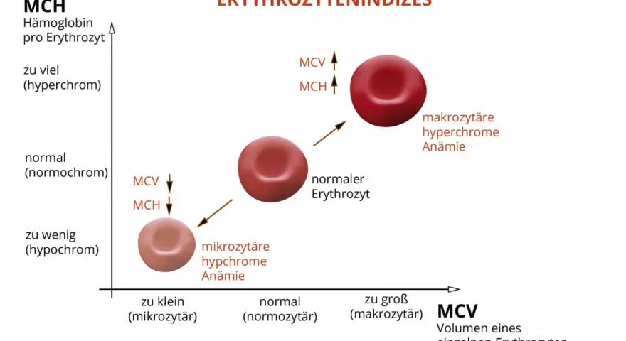 Diagramm zeigt Erythrozytenindizes: MCH (Hämoglobin pro Erythrozyt) und MCV (Volumen). Mikrozytäre, hypochrome Anämie bei niedrigem MCH/MCV. Makrozytäre, hyperchrome Anämie bei hohem MCH/MCV.