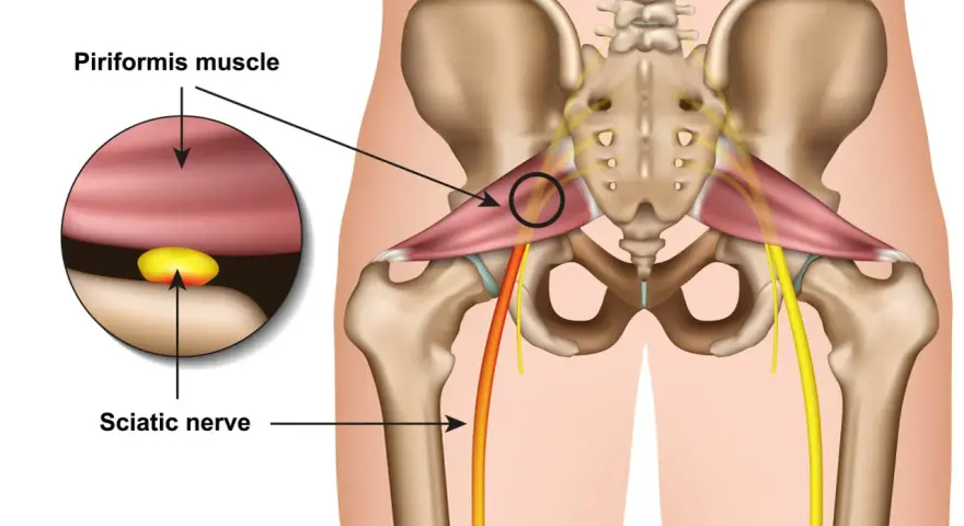 Illustration zeigt das Piriformis-Syndrom: Der Piriformis-Muskel drückt auf den Ischiasnerv.