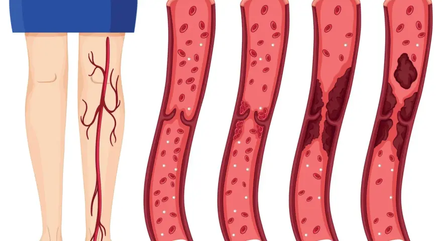 Illustration zeigt gesunde Wade und Blutgefäße mit zunehmender Thrombosebildung. Ein Thrombose Test Wade kann dies aufzeigen.