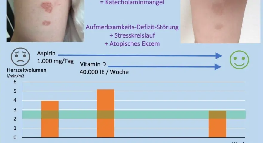 Vitamin D Mangel Symptome bei Erwachsenen: Erfahrungsberichte und Anzeichen