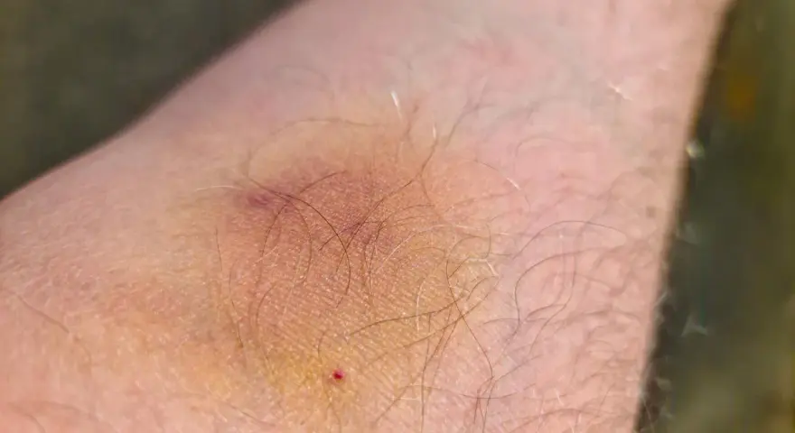 Ein blauer Fleck auf der Haut, der leicht juckt. Die Haut ist leicht gerötet und von feinen Härchen bedeckt.