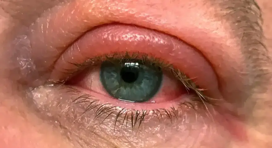 Widoczne zaczerwienienie i dziwna opuchlizna pod okiem, powieka jest wyraźnie spuchnięta i zaczerwieniona.
