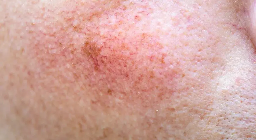Skóra z widocznymi naczynkami i przebarwieniami, czekająca na retinol efekty.