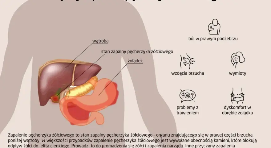 Anatomia człowieka z zaznaczonym pęcherzykiem żółciowym i objawami jego zapalenia: ból, wzdęcia, wymioty, problemy z trawieniem.