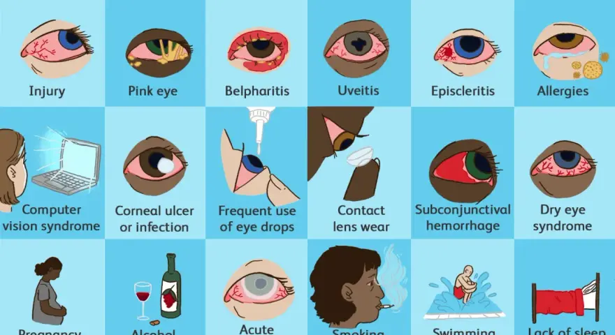 Molte cause possono portare a un occhio sempre rosso: dall'allergia all'uso di lenti a contatto, fino alla stanchezza.