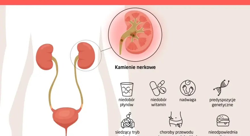 Ilustracja przedstawia przyczyny kamicy nerkowej, w tym kamienie nerkowe, niedobór płynów, witamin, nadwagę, predyspozycje genetyczne, siedzący tryb życia, choroby układu pokarmowego i moczowo-płciowego oraz nieodpowiednią dietę.