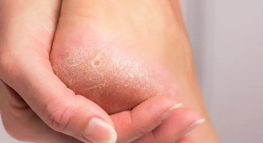 Gros plan sur un talon sec et craquelé, montrant des crevasses. Une main touche la peau pour illustrer comment soigner les crevasses.