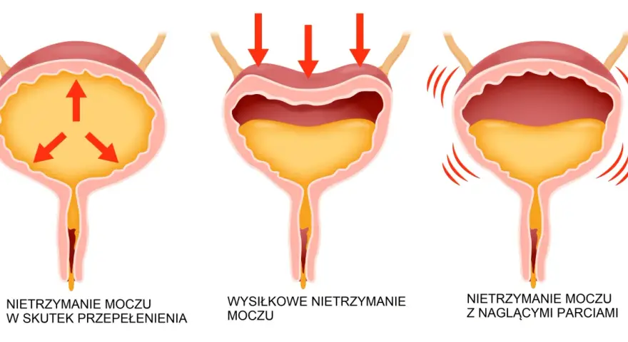 Ilustracja pokazuje trzy rodzaje popuszczania moczu: przepełnienie pęcherza, wysiłkowe i nagłe parcia.