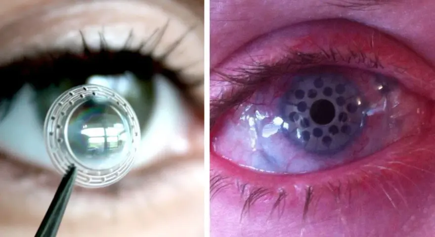 Lente per trapianto di retina in fase di applicazione e occhio con impianto retinico.