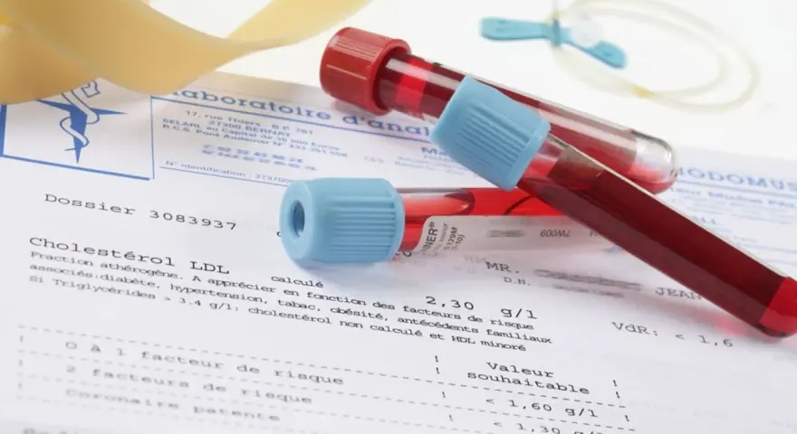 Próbki krwi w probówkach leżą na wynikach badań, gdzie widnieje m.in. poziom cholesterolu LDL. Wyniki mogą wskazywać na potrzebę monitorowania białka c reaktywnego.