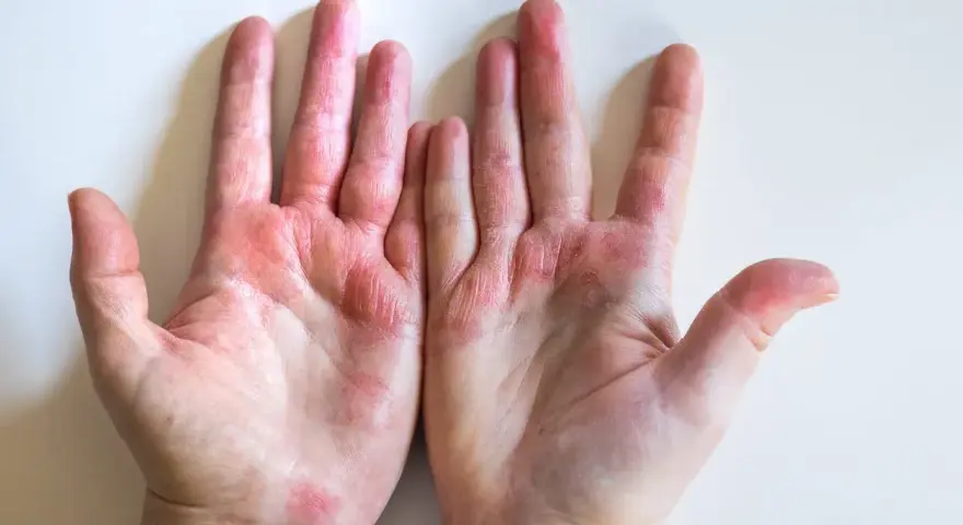 Manos con dishidrosis, mostrando piel enrojecida, seca y agrietada en palmas y dedos.