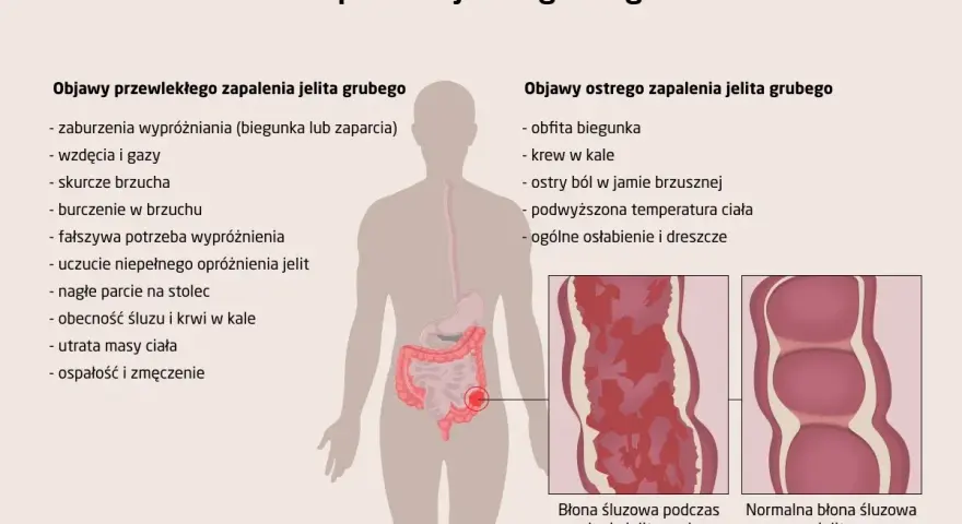 Zapalenie jelita grubego: objawy przewlekłe (biegunka, zaparcia, wzdęcia, bóle brzucha) i ostre (obfita biegunka, krew w kale, gorączka).