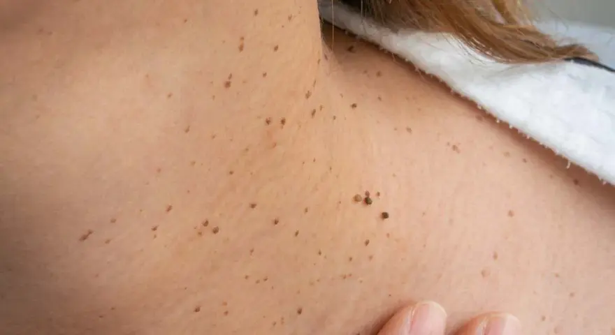 Primer plano de la piel del cuello con numerosas verrugas y lunares. Una mano toca suavemente la piel.