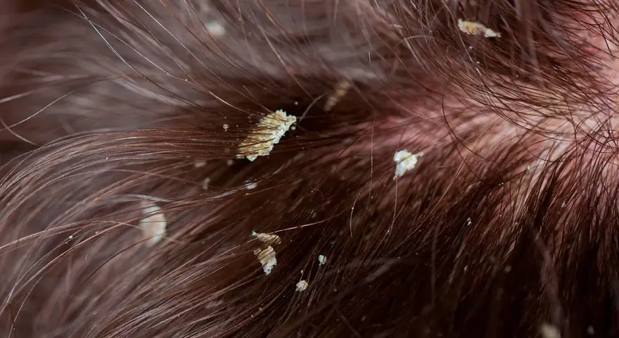 Primer plano de cabello castaño con descamación en el cuero cabelludo, mostrando escamas blancas y amarillentas entre los mechones.