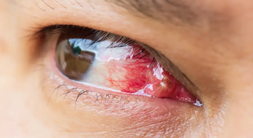 Occhio con pterigio arrossato e infiammato, in attesa di un intervento laser per rimuoverlo.