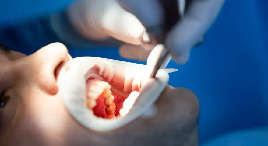 Dentysta wykonuje leczenie kanałowe zęba, używając narzędzi do precyzyjnej pracy w jamie ustnej pacjenta.