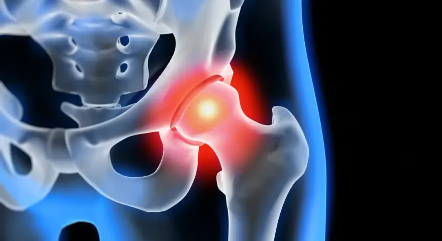 Coxarthrose Symptome: So erkennen Sie die schmerzhaften Anzeichen